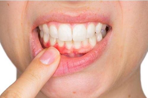 Điều bạn cần biết về bệnh viêm lợi