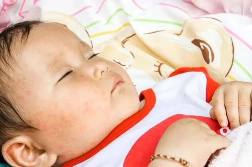 Nguyên nhân phổ biến gây sốt phát ban ở trẻ nhỏ