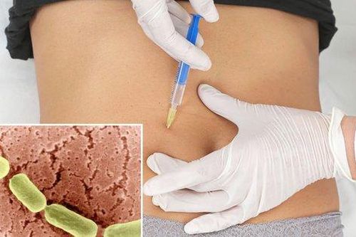 67 người ở châu Âu bị ngộ độc sau khi tiêm botox dạ dày để giảm cân