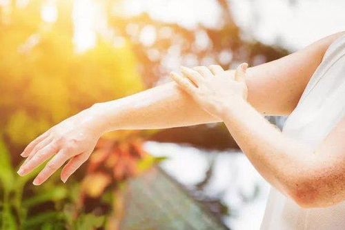 Người bị viêm da cơ địa cần tránh 5 điều này khi nắng nóng để bệnh không bùng phát