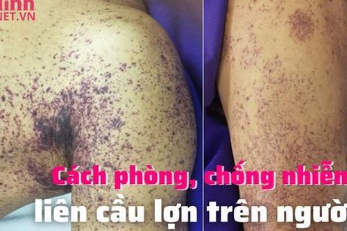 Cách phòng, chống nhiễm liên cầu lợn trên người