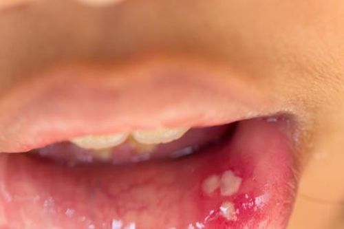Các thuốc thường dùng trong điều trị nhiệt miệng