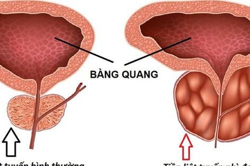 U phì đại tiền liệt tuyến: Nguyên nhân, hậu quả và phương hướng điều trị