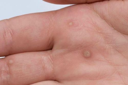 Mụn cóc và những điều bạn cần biết