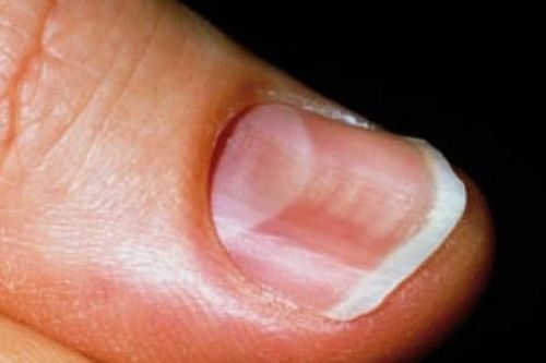 Móng tay biến dạng cảnh báo nhiều loại bệnh