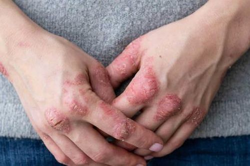 Viêm khớp vảy nến có chữa dứt điểm được không?