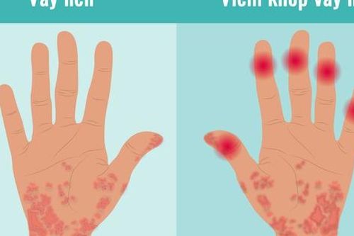 Bị viêm khớp vảy nến nên làm gì?