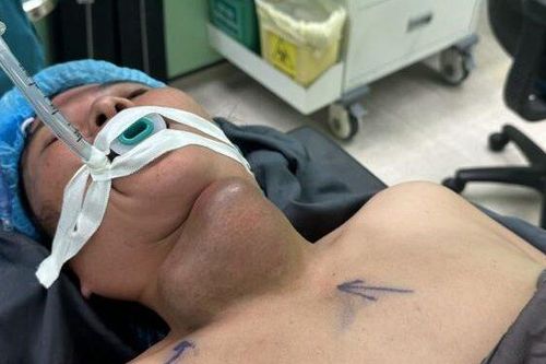 Tin tưởng thuốc nam, người phụ nữ nhập viện vì áp xe tuyến giáp