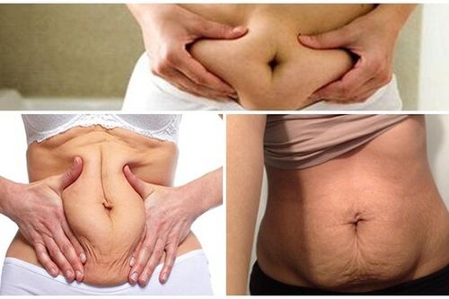 Khắc phục tình trạng da bụng bị chảy xệ, nhăn nheo