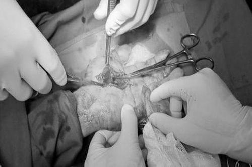 Người đàn ông bị mảnh vỡ cốc thủy tinh đâm đứt dây thần kinh giữa và động mạch tay nông