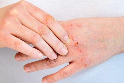 5 sai lầm trong điều trị viêm da cơ địa và cách khắc phục