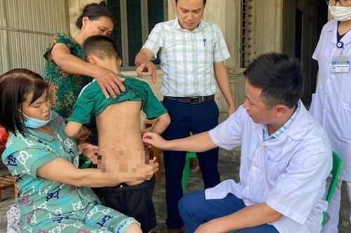 Hàng trăm người dân trong một thôn bị mẩn ngứa do bọ chét cắn