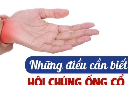 Hội chứng ống cổ tay: Nguyên nhân, biểu hiện và điều trị