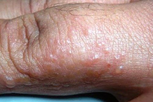 Xử lý bệnh ghẻ đang lây lan trong thôn có đông đồng bào dân tộc Cor