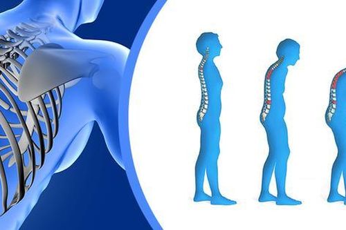 Loãng xương: 8 nhóm yếu tố nguy cơ bạn cần biết