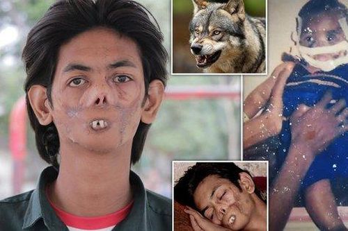 Bị sói tấn công từ khi còn nhỏ, chàng trai 18 tuổi bị dân làng xa lánh, gọi là 'cậu bé ma' vì ngoại hình biến dạng khiến nhiều người xót xa