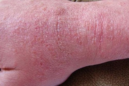 Những lưu ý khi dùng thuốc điều trị chàm