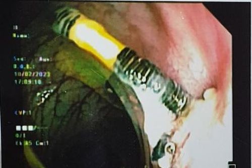 Người phụ nữ 38 tuổi nhập viện vì vòng tránh thai đâm xuyên thành tử cung