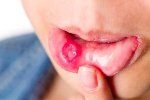 Dấu hiệu sớm cảnh báo ung thư lưỡi nhưng thường dễ nhầm lẫn