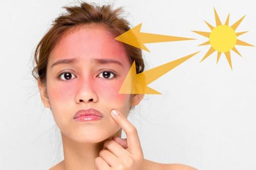 Điều bạn tuyệt đối không nên làm khi da bị cháy nắng