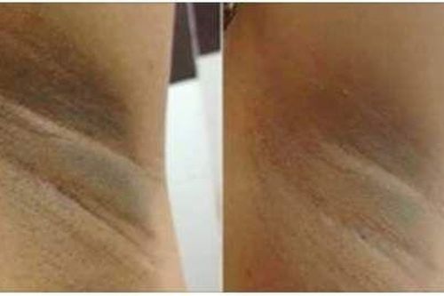 Trị thâm nách an toàn tiết kiệm bằng cách sử dụng phấn rôm