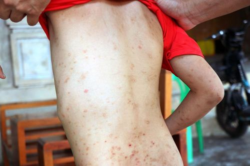 Xử lý ổ côn trùng bọ chét ký sinh trên vật nuôi lây sang người