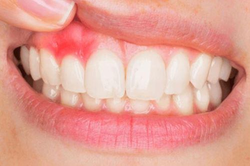 Thường xuyên chảy máu chân răng: Cảnh báo 4 căn bệnh nguy hiểm đừng chủ quan