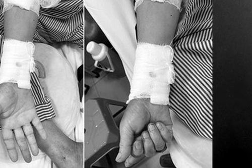 Ngủ dậy bất ngờ tê bì, đau nhức tay, người đàn ông gặp nguy hiểm, suýt phải cắt bỏ bàn tay