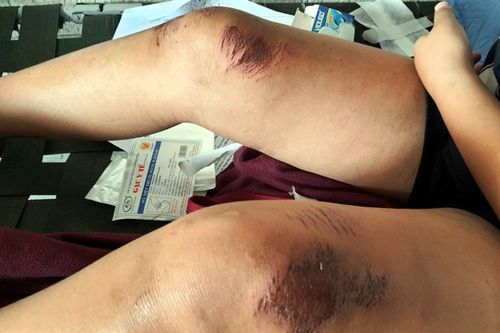 TP Hồ Chí Minh: Cướp điện thoại rồi kéo lê bé gái 13 tuổi trên đường