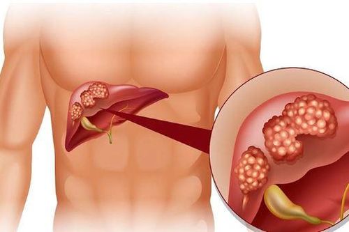 4 hiểu lầm về bệnh viêm gan B