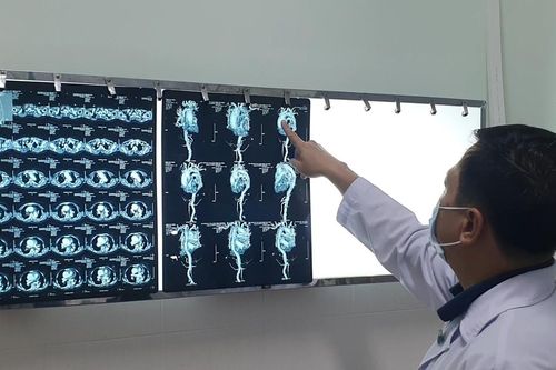 5 giờ phẫu thuật cứu bệnh nhân vỡ túi phình động mạch chủ, nguy cơ tử vong cao