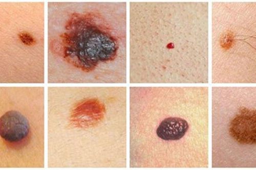 Tẩy nốt ruồi có kích thích tế bào ung thư phát triển không?