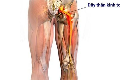 Liệu pháp mới giúp giảm đau thần kinh tọa