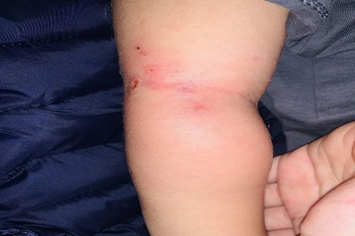 Bé 25 tháng tuổi nhiễm khuẩn huyết từ vết muỗi đốt