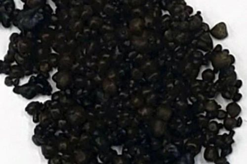 Người phụ nữ có hơn 400 viên sỏi trong túi mật