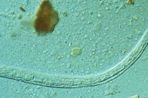 Nhiễm giun lươn nghiêm trọng, người đàn ông Tây Ban Nha rơi vào cảnh đáng sợ