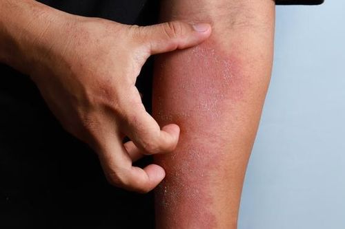 Phát ban da do clo khi đi bơi và những điều cần biết