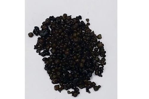 Hơn 400 viên sỏi trong túi mật của người phụ nữ 44 tuổi