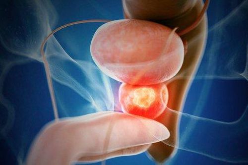 Tại sao bị ung thư tiền liệt tuyến?