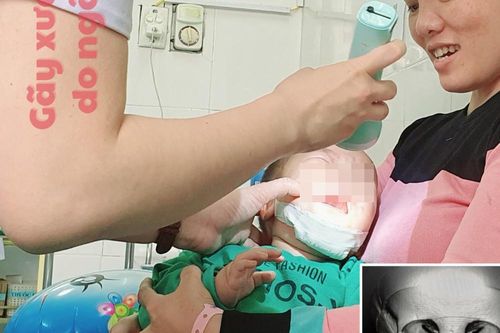 Bé 10 tháng tuổi gãy xương hàm vì ngã xe đẩy