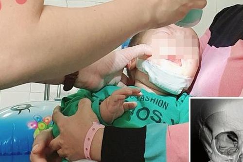Ngồi xe đẩy chơi đùa cùng anh chị, bé 10 tháng tuổi ngã gãy xương hàm