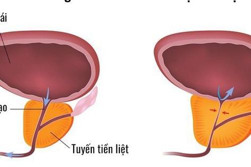 Phì đại tiền liệt tuyến có chữa được không?