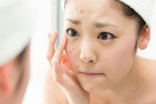 Làm thế nào để da không nổi mụn trong mùa hè?