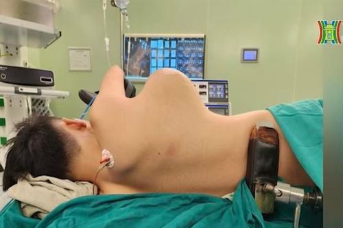 Phẫu thuật thành công khối u 3kg trong lồng ngực thiếu niên