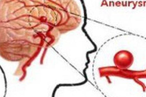 Phát hiện sớm phình động mạch não