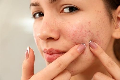 Những nguyên nhân gây ngứa da mặt