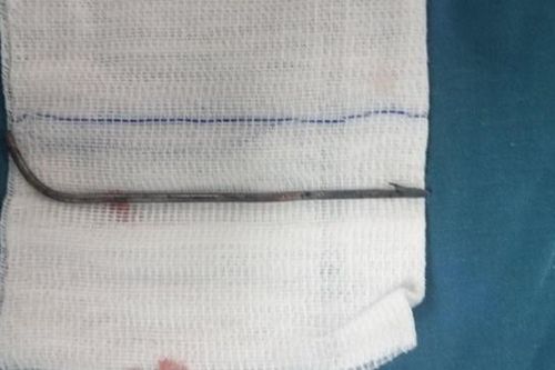 Quảng Trị: Phẫu thuật lấy mũi tên bắn cá ra khỏi người nam thanh niên