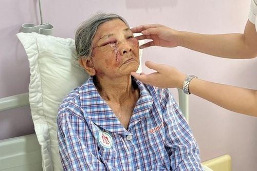 Phát hiện ung thư da từ nốt ruồi ở mi mắt