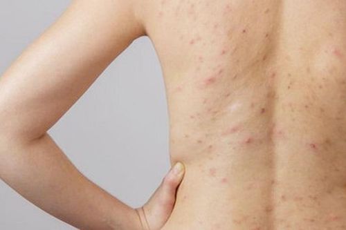 Chữa viêm lỗ chân lông hiệu quả bằng loại quả quen thuộc