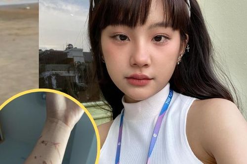Hot girl người Tày Ceri Thu Hà lần đầu nói về các vết thương chằng chịt trên cánh tay